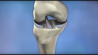 ACL Injury Prevention  Mayo Clinic [upl. by Lorimer]