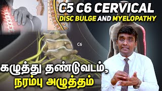 C5 C6 Cervical Disc Bulge and Myelopathy கழுத்து தண்டுவடம் நரம்பு அழுத்தம் Part 1 [upl. by Sneve]