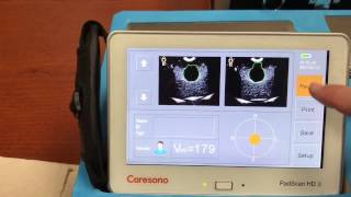 Caresono Padscan HD3 Bladder Scanner [upl. by Helga]