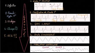 Hyperkaliémie  PseudoHyperK  Clinique ECG  Étiologies  Traitement  Docteur Synapse [upl. by Nalac827]