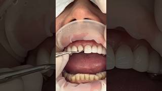 Zirconia post ceramic crown dentalcare dentalclinic dentist toothache tooth toothloss [upl. by Behre320]