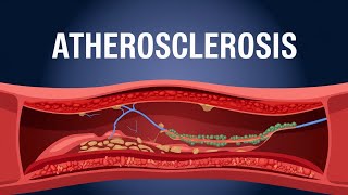 Atherosclerosis animation understanding Atherosclerosis [upl. by Popele724]