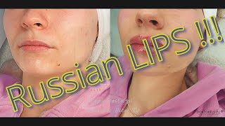 Russian LIPS  dr Ledniowska [upl. by Eydie135]