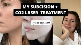 1 Year later  Subcision and ablative CO2 Laser Results [upl. by Debora192]