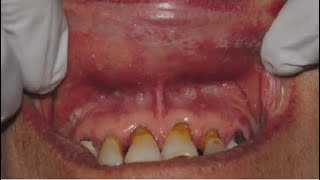 Association of Systemic Drugs in Oral Lichenoid Reaction [upl. by Nerual]