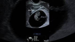 8 weeks fetus subchorionic hemorrhage peri sac hematoma ultrasound ardms sonography radiology [upl. by Milicent230]