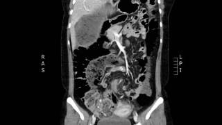 Volvulus CT Coronal JETem 2017 [upl. by Doralynne]