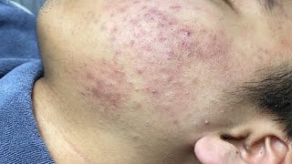 ACNE TREATMENT VU QUYNH MI Acne On Teens Cheek 2024 [upl. by Ilam501]