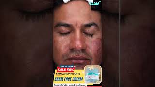 Do you know this melasma solution Remove melasma from 2 weeks melasmacream melasmatreatment [upl. by Yhtac]