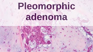 Pleomorphic Adenoma of Salivary Gland [upl. by Olethea848]