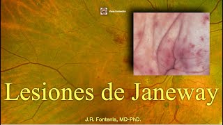 Lesiones de Janeway Endocarditis Bacteriana [upl. by Newlin]