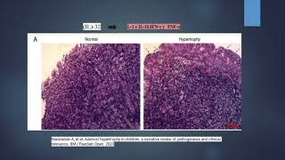 Manejo quirúrgico de hipertrofia adenoidea con Adenoidectomía vía transnasal endoscópica [upl. by Ahsilac546]