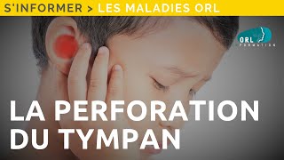 Perforation du tympan  Information patient [upl. by Akere]