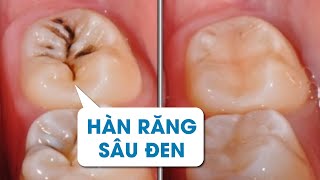 Hàn răng sâu đen như thế nào  FB Bác Sĩ Tuệ [upl. by Atteiram]