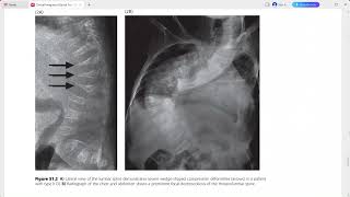 CLINICAL IMAGING OF SPINAL TRAUMA [upl. by Aitahs457]