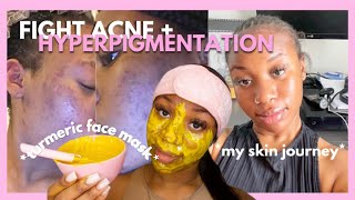 EASY DIY Turmeric Face Mask Tutorial for ACNE amp HYPERPIGMENTATION  How to get CLEAR SKIN in 2024 [upl. by Leyes]