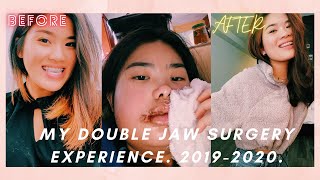 My Double Jaw Surgery Experience class 3 underbite [upl. by Armillda456]