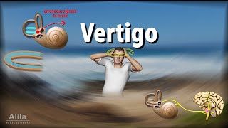 Vertigo Causes Pathophysiology and Treatments Animation [upl. by Somar924]