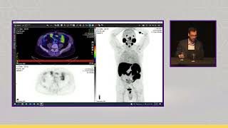 PSMA PETCT Tumor Board  MultiDisciplinary Meeting Live at ProsTIC22 [upl. by Ennaisoj]