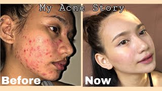 How I Cleared My Skin in 2 Months Using Affordable Products  Pictures  Philippines [upl. by Budwig214]