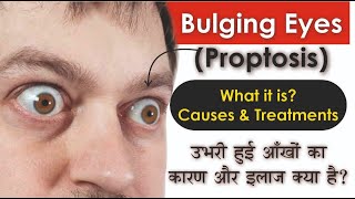 What is Bulging Eyes Proptosis Causes amp Treatments  उभरी हुई आंखों का असल कारण क्या है [upl. by Screens]