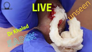 Multiple Cyst Removal Part 2 Dr Khaled Sadek LipomaCystcom [upl. by Halilak]