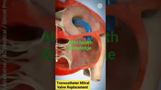 Transcatheter mitral valve replacement ytshorts [upl. by Shelbi]