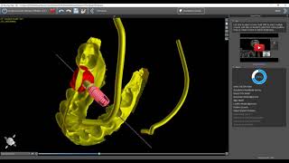 BSP49  Step by Step Implant Planning Wizard [upl. by Jereld]