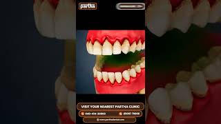 Periodontics Treatment at Partha Dental  Expert Care for Your Gums [upl. by Nongim767]