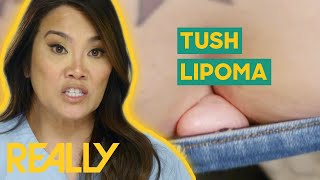 Dr Lee Removes StrawberrySized Lipoma From Womans BOTTOM  Dr Pimple Popper [upl. by Salsbury]