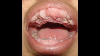 Gum Disease II Under 60 Seconds Explained By A DOCTOR [upl. by Gordon613]