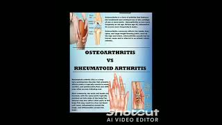 OsteoarthritisOsteoarthritis shorts youtubeshort viral shortfeedclips [upl. by Jollanta]