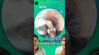 DRY EARWAX EXTRACTION earwaxremoval earcleaning blockedears [upl. by Warchaw]