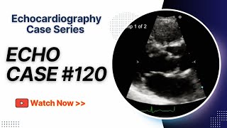 Echocardiography Case 120  Echo Spot Diagnosis Case Series [upl. by Namyw]