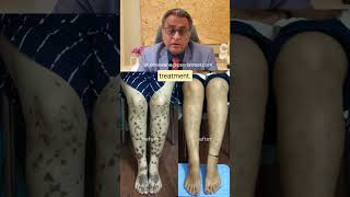 Lichen Planus Recovery Story How Homeopathy Healed Severe Skin Lesions  Psoriatreat Clinic [upl. by Pump]