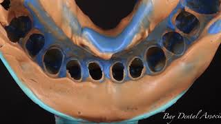 Feldspathic Veneers [upl. by Noraa]