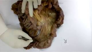 Evidence of Continuity of Mesentery from Duodenum to Rectum from Human Cadaveric Dissection [upl. by Eyahc922]