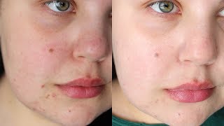 AFFORDABLE LASER TREATMENT FOR ACNE SCARS  IPL Laser Before amp After [upl. by Weitman169]