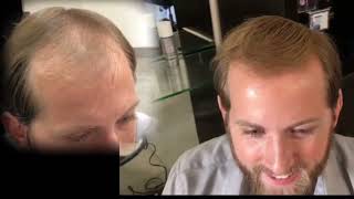 Bald Spots Thinning hair No More The HairCubed Fibers 30 SECOND Transformation [upl. by Belcher]