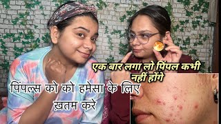 How to Remove Pimples and Acne  Face Se Pimple Kaise Hataye  Pimple Home Remedy [upl. by Aevin]