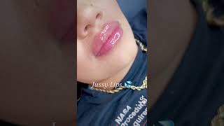 Hyaluron Pen Lips Needle free lip fillers using dermalax deep plus [upl. by Onia845]