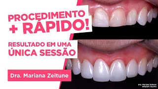 TRANSFORME SEU SORRISO Facetas e lentes de contato em resina composta Saiba tudo [upl. by Waltner]