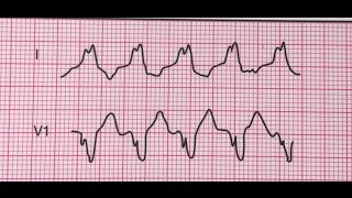 Tachycardie ventriculaireMorphologie du bloc de branche gauche [upl. by Sadnak]
