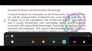 chapter 160 tintinalli emergency medicine head trauma [upl. by Notsnorb234]