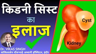 Kidney Cyst Treatment ✅ Kidney ki gathan ka ilaaj Renal Cyst  By Dr Vikas Singh Urologist [upl. by Adleremse]