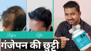 Baldness cure by Replicels Rch01  Rch01 for hair loss  Rch 01 Results  Hair Transplant [upl. by Nythsa]