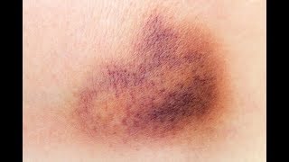 Dicas simples para eliminar hematomas mais rápido [upl. by Anneyehc]