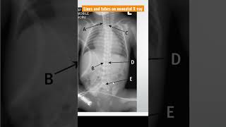 Lines and tubes on neonatal Xray neonatalradiology Xray lineposition [upl. by Latvina]