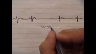 ECG simplified  Sinoatrial block [upl. by Yliab746]