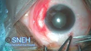 Pterygium Surgery with conjunctival autograft sutureless and glueless [upl. by Eibur]